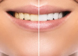 Zahnaufhellung in Photoshop: Zähne aufhellen dezent-realistisch Zahnaufhellung mit Photoshop